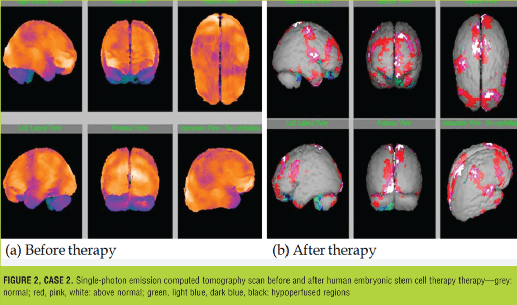 在大腦和小腦區域觀察到的灌注程度顯著降低（圖 2）