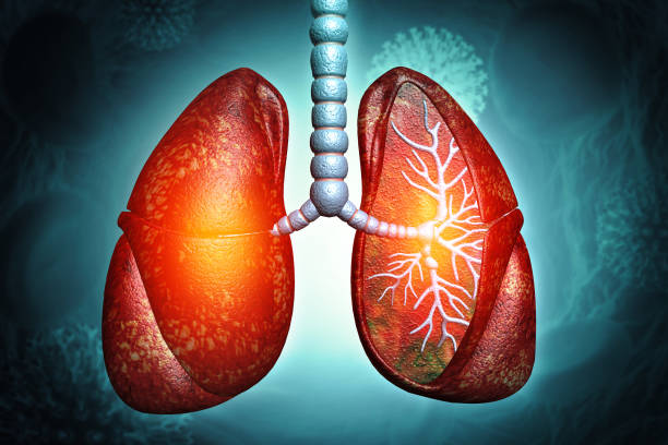 間充質干細胞治療4大類肺部疾病的臨床試驗進展及挑戰 間充質干細胞治療4大類肺部疾病的臨床試驗進展及挑戰