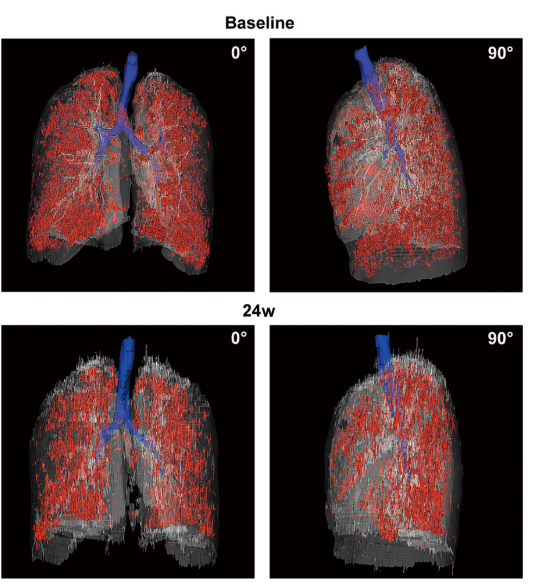 患者 #2902 自體 P63 細胞移植前和后 24 周連續(xù)肺部 CT 圖像的三維可視化。 患者 #2902 自體 P63 細胞移植前和后 24 周連續(xù)肺部 CT 圖像的三維可視化。
