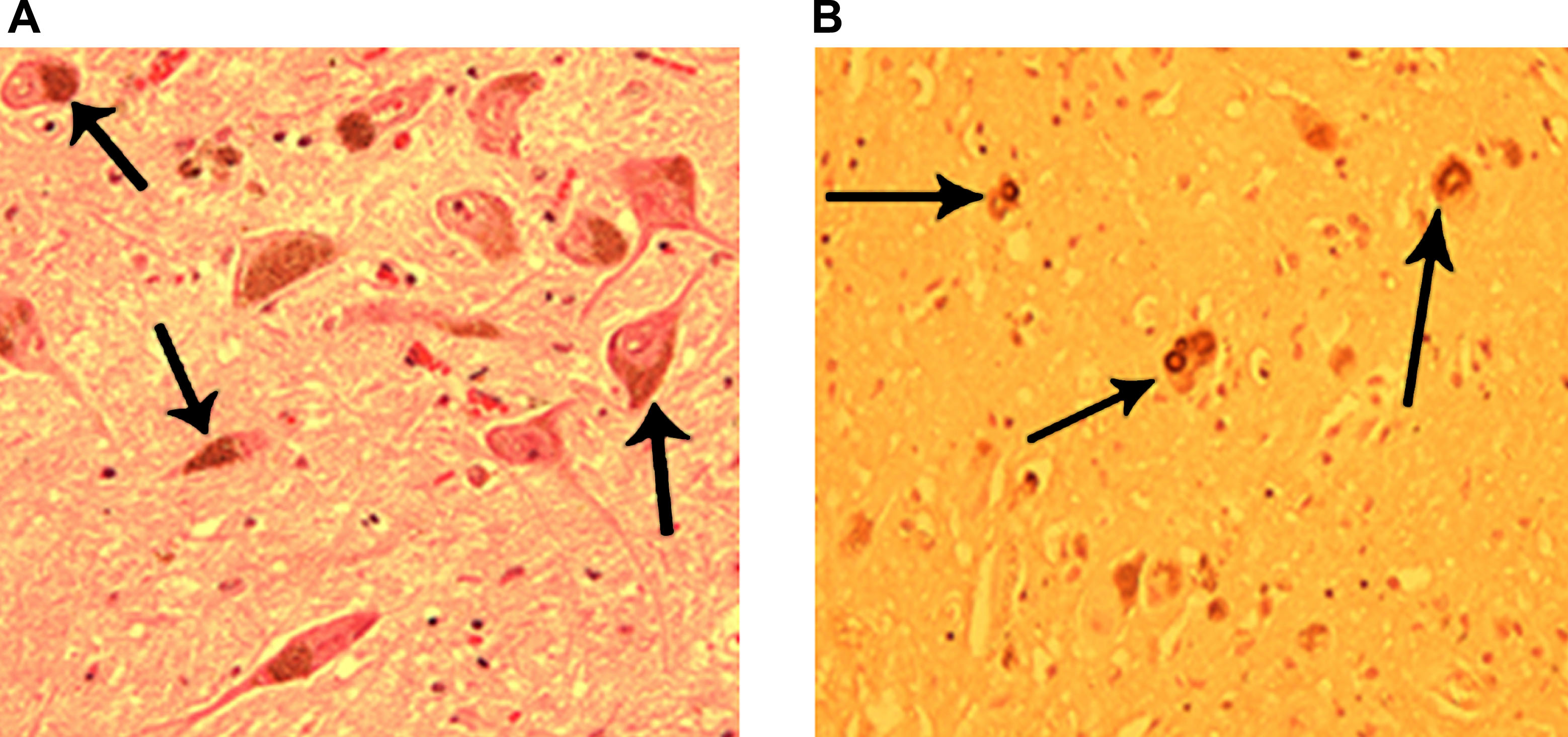圖3：正常和帕金森病患者的黑質。