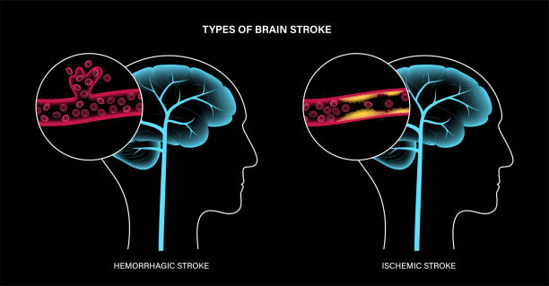 從癱瘓到復?。∩窠浉杉毎煼?大機制如何促進中風后的大腦修復？