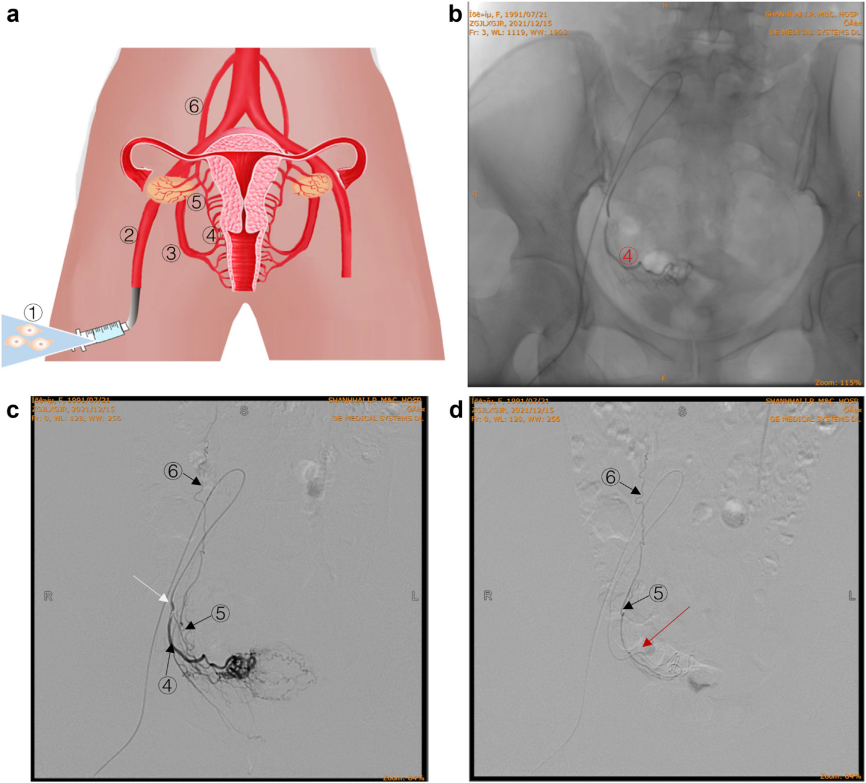 經卵巢動脈精準輸注hAEC 經卵巢動脈精準輸注hAEC