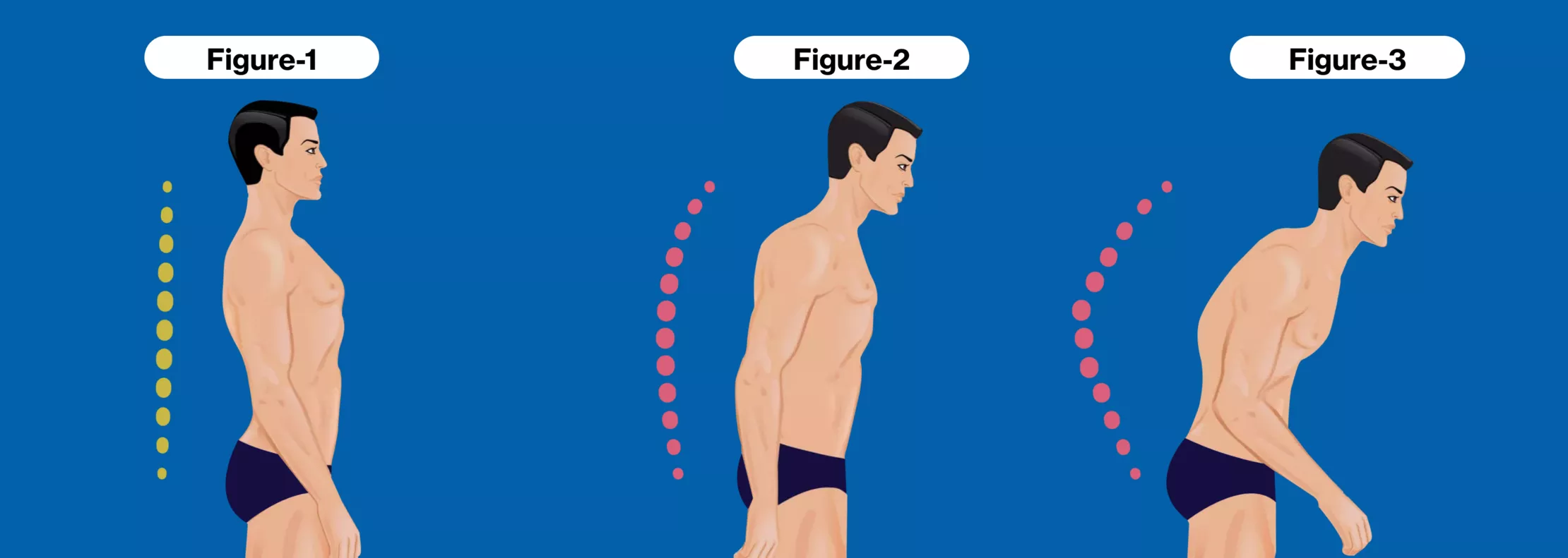 2025強直性脊柱炎治療指南:5種最新治療方法的臨床突破 2025強直性脊柱炎治療指南:5種最新治療方法的臨床突破