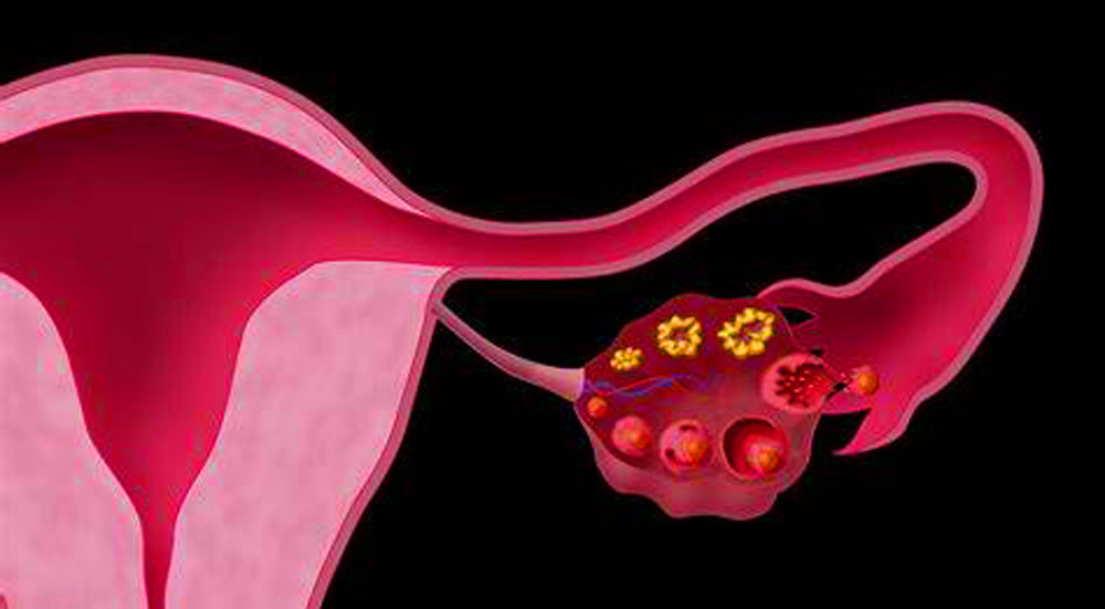 卵巢早衰 卵巢早衰