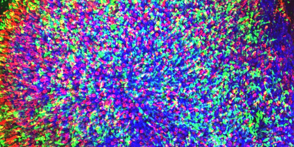 視網膜色素變性 視網膜色素變性