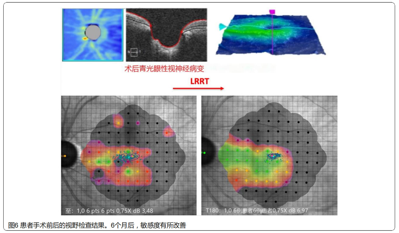 青光眼臨床試驗 青光眼臨床試驗