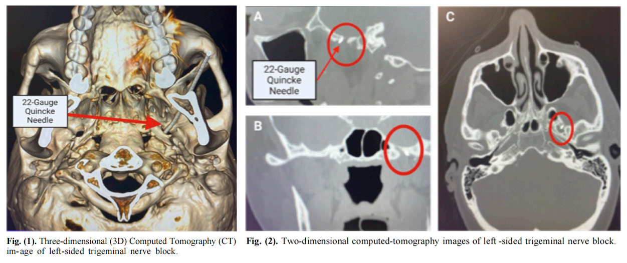三叉神經(jīng)痛臨床試驗(yàn) 三叉神經(jīng)痛臨床試驗(yàn)