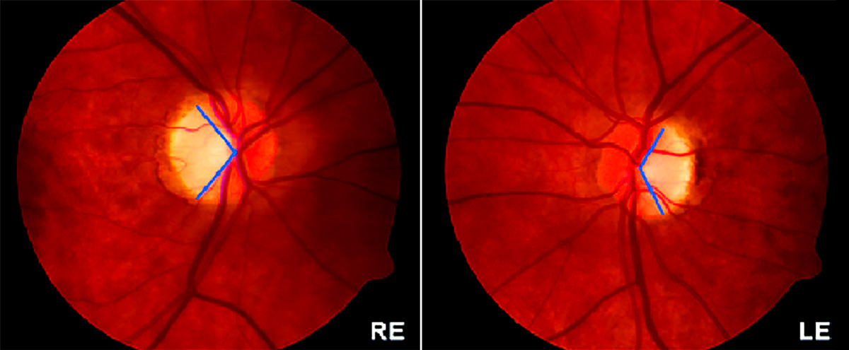顯性視神經萎縮