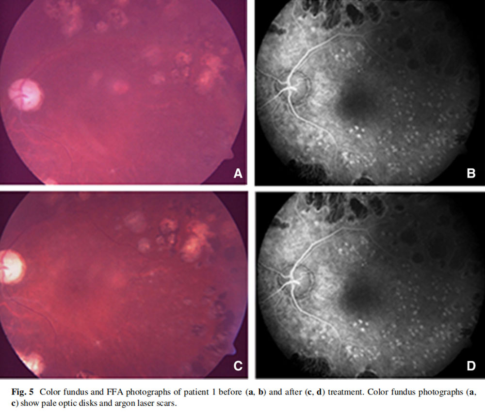 視神經萎縮臨床試驗 視神經萎縮臨床試驗