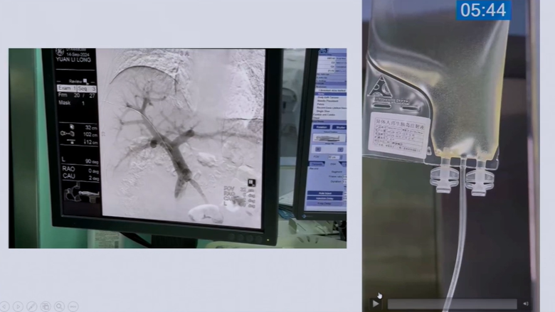 殷浩教授展示了干細(xì)胞療法的治療過程 殷浩教授展示了干細(xì)胞療法的治療過程