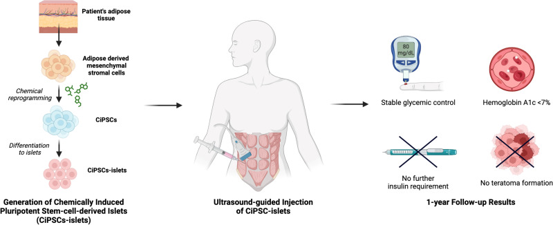 圖示：?通過將患者脂肪組織提取的間充質(zhì)干細(xì)胞化學(xué)重編程為誘導(dǎo)多能干細(xì)胞并分化為胰島，再注射入腹直肌前鞘。