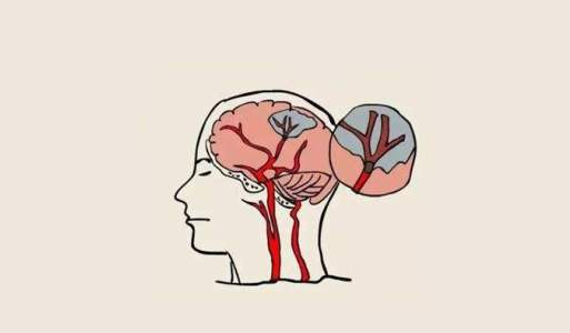 中風后的腦損傷,真的能被干細胞療法逆轉嗎? 中風后的腦損傷,真的能被干細胞療法逆轉嗎?