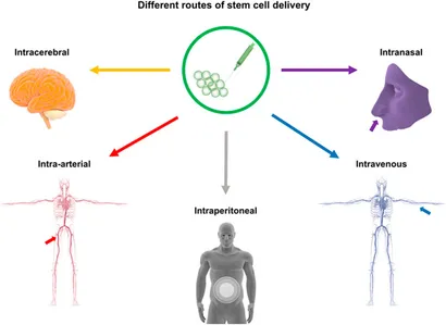 干細(xì)胞移植途徑:該圖展示了用于中風(fēng)治療的干細(xì)胞輸送途徑,包括腦內(nèi)(立體定向注射)、血管內(nèi)(靜脈/動脈)、腹腔內(nèi)、腦室內(nèi)、靜脈內(nèi)、鼻內(nèi)和鞘內(nèi)注射方法。 干細(xì)胞移植途徑:該圖展示了用于中風(fēng)治療的干細(xì)胞輸送途徑,包括腦內(nèi)(立體定向注射)、血管內(nèi)(靜脈/動脈)、腹腔內(nèi)、腦室內(nèi)、靜脈內(nèi)、鼻內(nèi)和鞘內(nèi)注射方法。